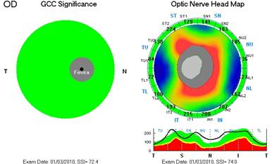 tomografia opctica coherente oct neuritis optica